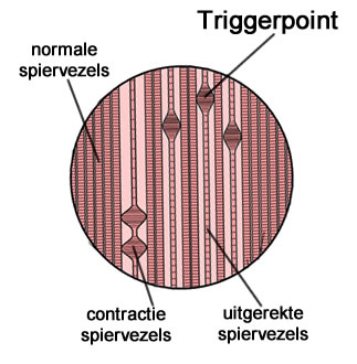 triggerpoint-spiercontractie